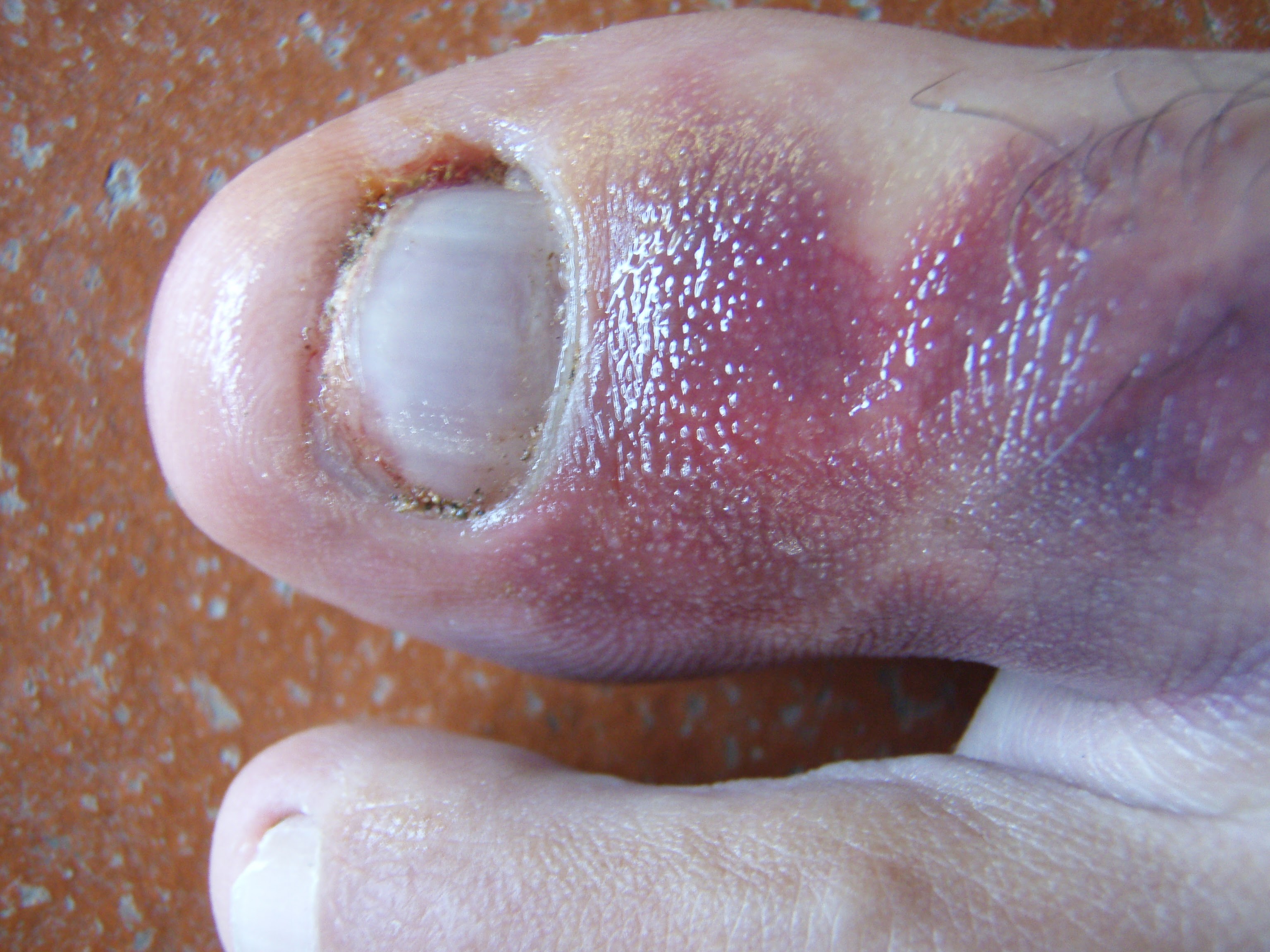 Dedo morado